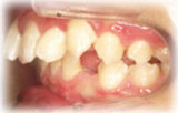 歯科矯正前1