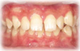 歯科矯正前2