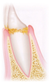 歯周病の進行度　歯の根元部分に汚れが付着
